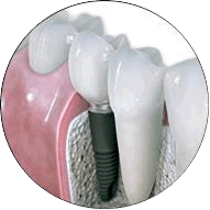 Parts of a dental implant