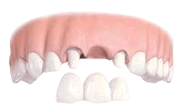 Dental implants as an alternative to a dentl bridge