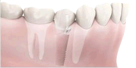 Bone loss