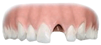 Replacing one tooth