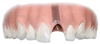 Installing an implant