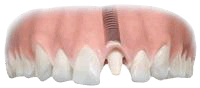 Installing an abutment