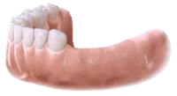 Replacing several teeth