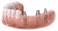 Multiple dental implants