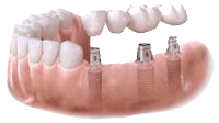 Multiple abutments