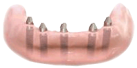 Anchoring with a dental implant bridge