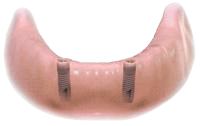 Overdenture