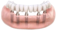 Abutments attached to dental implants and bridge