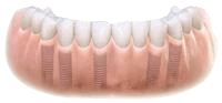 Dental implant bridge