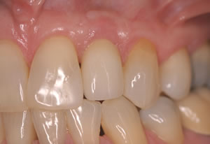 Periodontal Disease