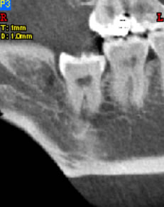 Wisdom Teeth