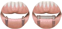 Dental implants Salem OR