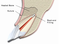 Repairing with a root canal